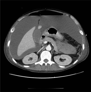 Abdominal CT scan image revealing pneumoperitoneum and massive ascites.