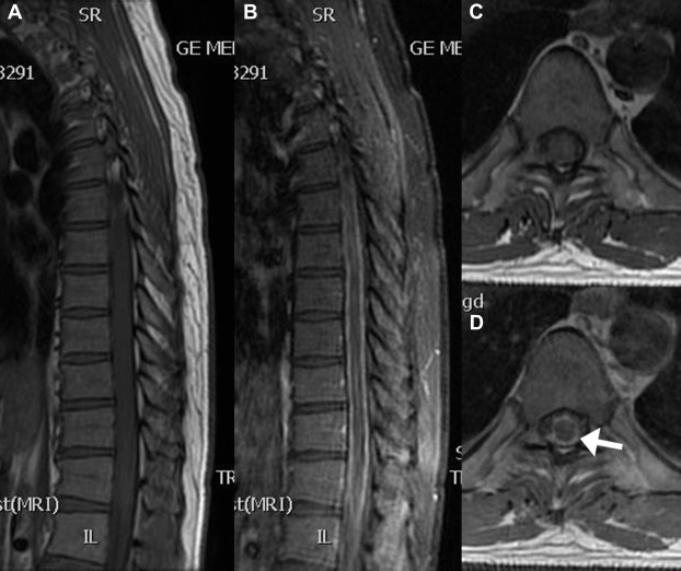 Pre- (A, C) and postcontrast (B, D) T1-weighted MR images of the thoracic spine ...