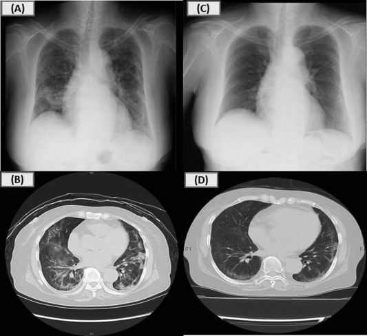 Chest X-rays and CT scans on admission and after treatment. Chest radiograph on ...