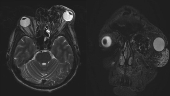 Magnetic resonance imaging shows a large heterogeneous soft tissue lesion with ...