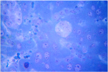 Metastases of tumour cells in the liver and increased content of macrophages, ...