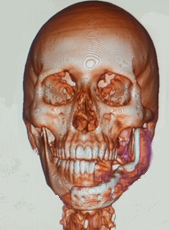 Frontal plane.\label{F9a}