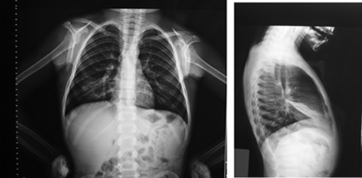 Posteroanterior and lateral radiographs of five-year-old child with atelectasis ...