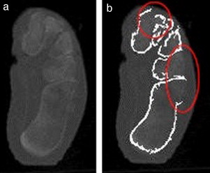 Ejemplo de fallo de la segmentación en una imagen de TC de baja resolución ...