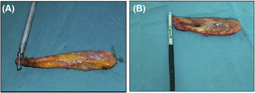 (A) Sealing of the cystic duct using harmonic scalpel, (B) Sealing of the cystic ...