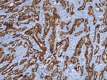 Tumor adenomatoide paratesticular – marcação imuno‐histoquímica positiva para ...