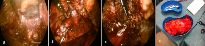 Nefrectomia citorredutora laparoscópica direita. a) Laqueação do ureter, b) ...