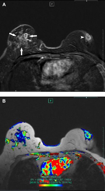 (A,B) MRI images of bilateral IGM. (A) Contrast enhanced T1 weighted reformat ...