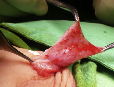 Degloving and dissection down to the penile base, dividing the fibrotic tissue. ...