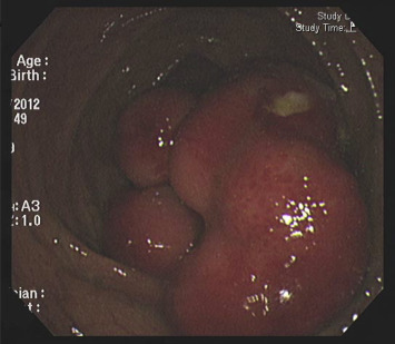A large, sessile, hard polypoid tumor with a congestive overlying mucosa and ...