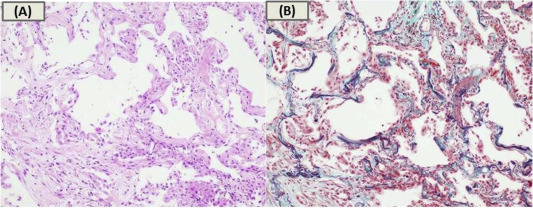 Histological findings obtained from transbronchial biopsy. Histological findings ...