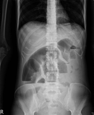 Plain abdominal film shows segmental dilatation of jejunal loops and intestinal ...