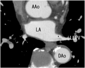 64-MDCT axial images showed thrombi in the left lower pulmonary vein (LLPV) ...