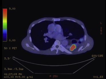 Positron emission tomography–computed tomography scan showing FDG avid colonic ...