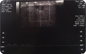 Nódulo hipoecogénico de 7,5mm com sinal Doppler presente.