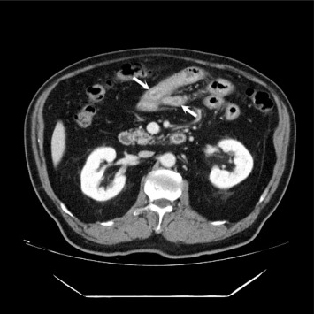 The abdominal computed tomography scan shows a long segmental luminal narrowing ...