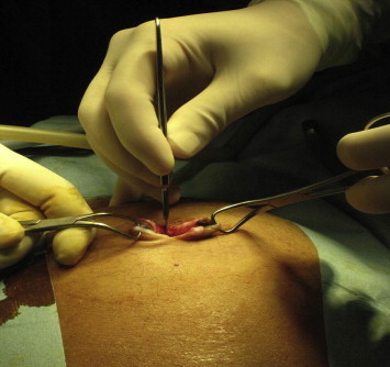 Transumbilical incision.