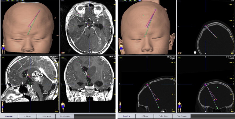 ETV and ETB trajectory reconstruction: The preoperative MRI image and ...