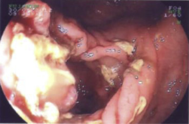 Endoscopic image of tumor arising from the colonic interposition graft.