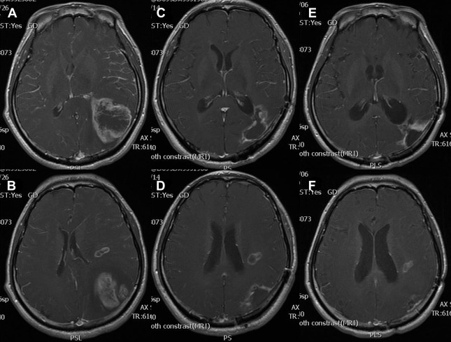 Gadolinium-enhanced axial T1-weighted MRI showing the intracranial tumors prior ...