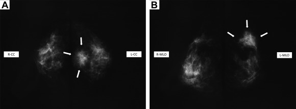 Mammography. (A, B) Mammography reveals a 3.8-cm mass shadow with an unclear ...