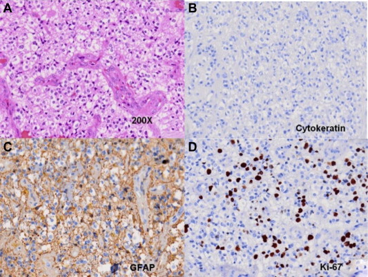 (A) Hematoxylin and eosin staining shows plenty of tumor cells with ...