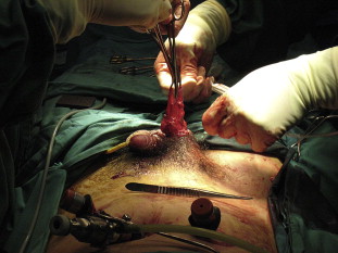 Ligation of the sac before re-insufflation of the abdomen.