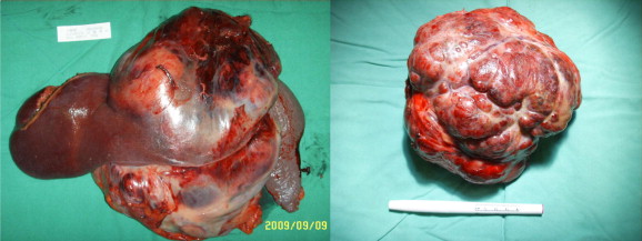 Gross photograph of undifferentiated embryonal sarcoma of the liver.