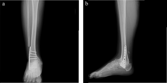 (a and b). Postoperative anteroposterior and lateral views at 6-month follow-up.