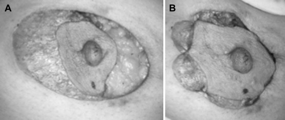 Periareolar incision was approximated in an RBT case. (A, B) No purse-string ...