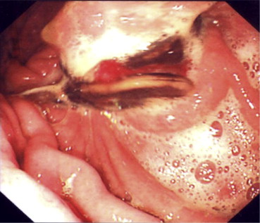 Preoperative upper gastrointestinal endoscopy showing erosion of the gastric ...