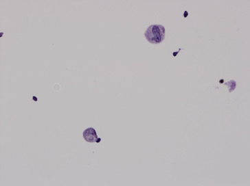 CSF cytology. A few atypical cells are apparent, with enlarged round to oval ...