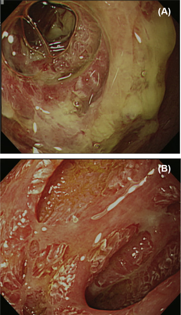 Endoscopic photographs of cytomegalovirus disease in the small intestine. (A) ...