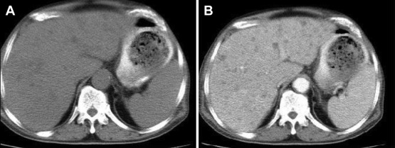 Abdominal computed tomography reveals (A) multiple low density lesions (B) ...