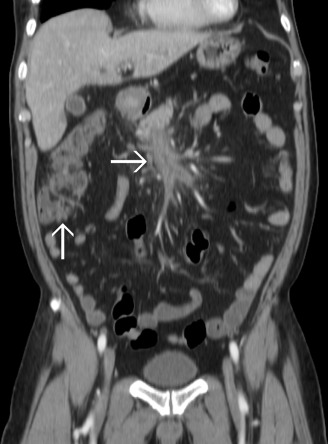 The upward arrow indicates the improved diverticulitis and the rightward arrow ...