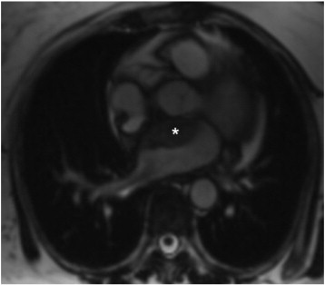MRI showing atrial hematoma (asterisk) in contact with aortic root.