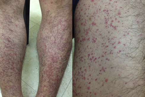 Several erythematous papules and macules over the bilateral lower extremities.
