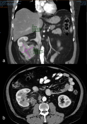 a) Tumor do polo inferior do rim direito, com 9cmx7 após realização de sunitinib ...