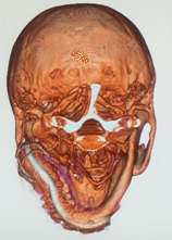 Transverse plane.\label{F9b}