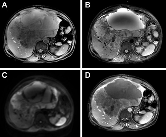 A large, well-defined, lobulated mixed cystic and solid lesion occupying both ...