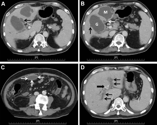 Contrast-enhanced CT scan. (A, B) Marked gallbladder distention (G), 55 mm in ...