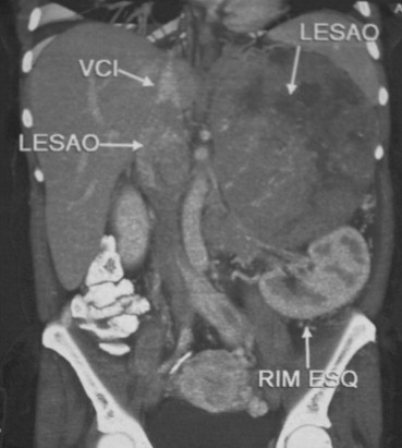 Computed tomography scan showing a voluminous mass, with inferior vena cava ...