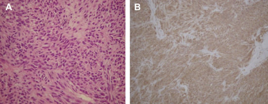 (A) The tumor specimen appeared spindle-shaped and arranged in a bundle ...