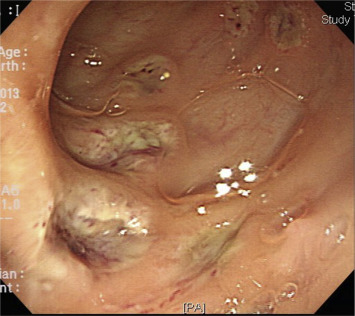Colonoscopy image showing well-demarcated ulcerations in the sigmoid colon.