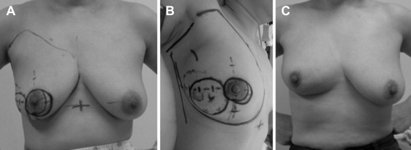 Case with fair cosmetic results. The excision volume was 20% and the tumor was ...