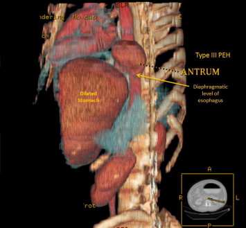 Three-dimensional image from tomography scan demonstrating herniation of the ...