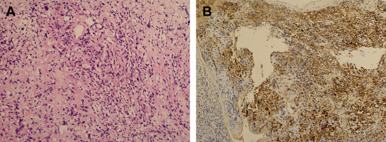 (A) Photomicrograph illustrating elongated bipolar spindle cells with ...