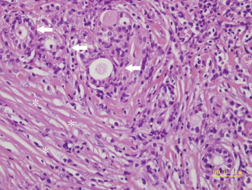 Thyroid residual follicles (arrows) were disorganized by fibro-inflammatory ...