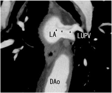 64-MDCT coronal images showed thrombi in the LUPV, illustrated more clearly than ...
