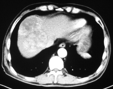 Abdominal computed tomography image of a 9-cm tumor located in segment 8.
